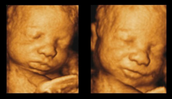 Ultrasound Image
