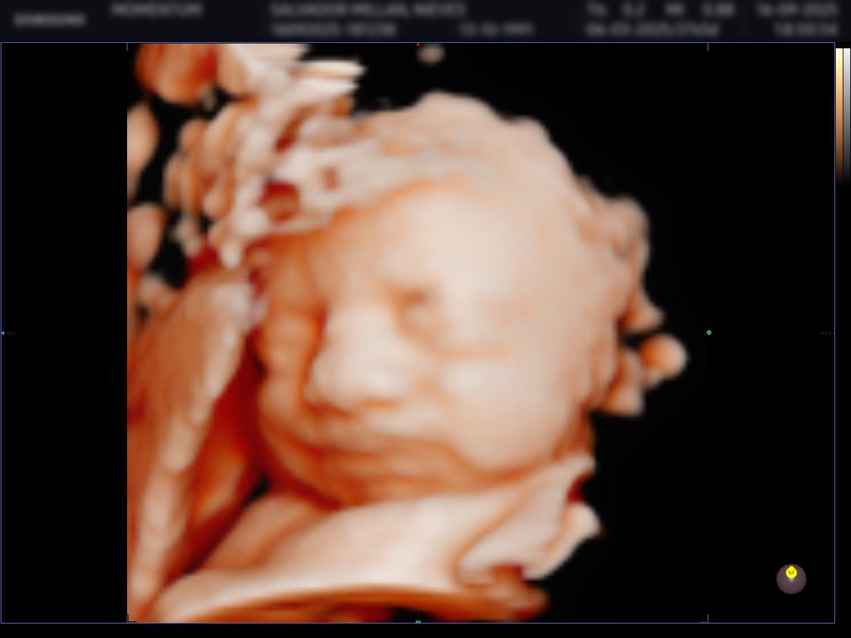 Ecografía 3D antes del procesamiento con IA — BabyFaceReveal
