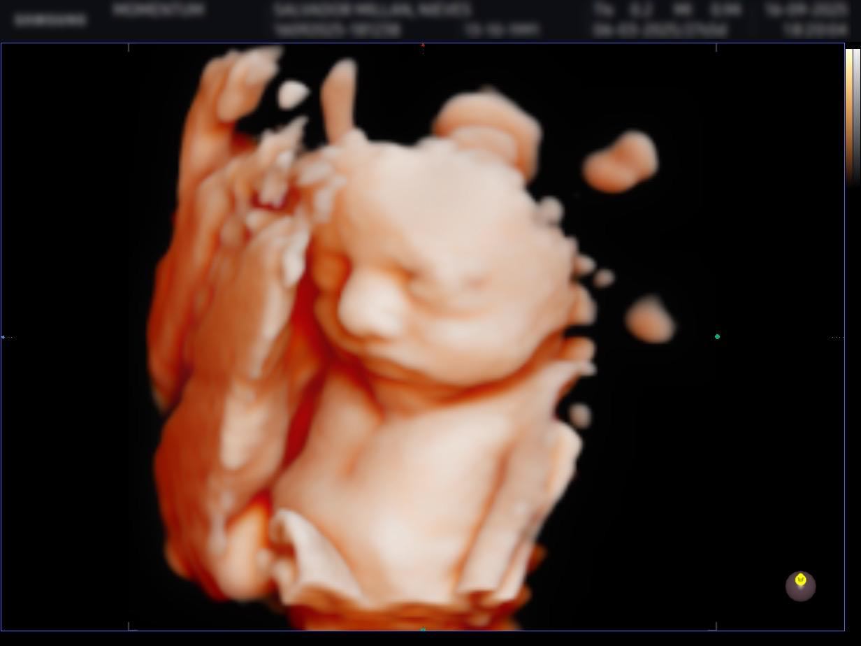 Ecografía 3D antes del procesamiento — BabyFaceReveal