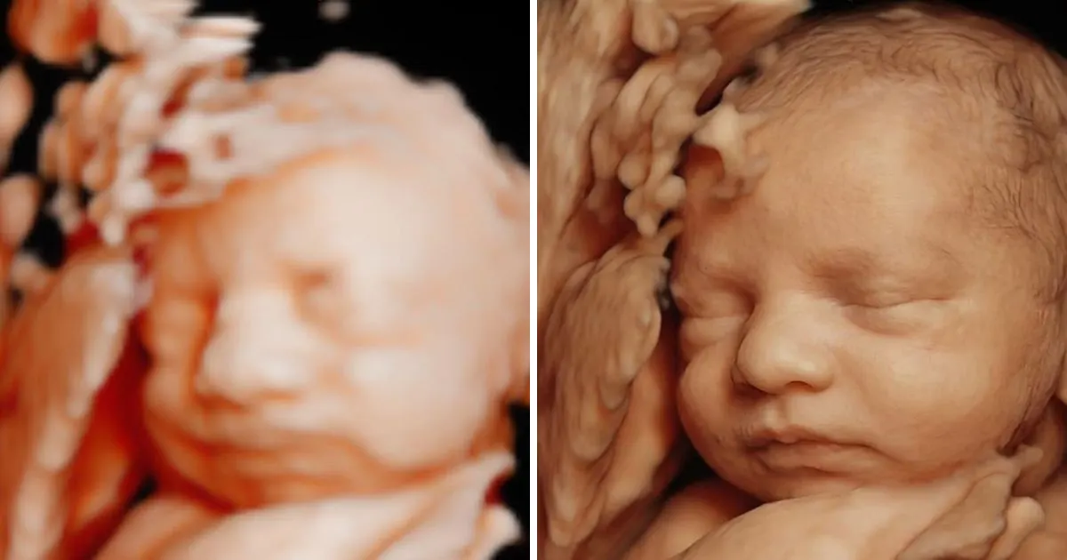 5D ultrasound of a baby’s face next to its 8K hyperrealistic enhancement