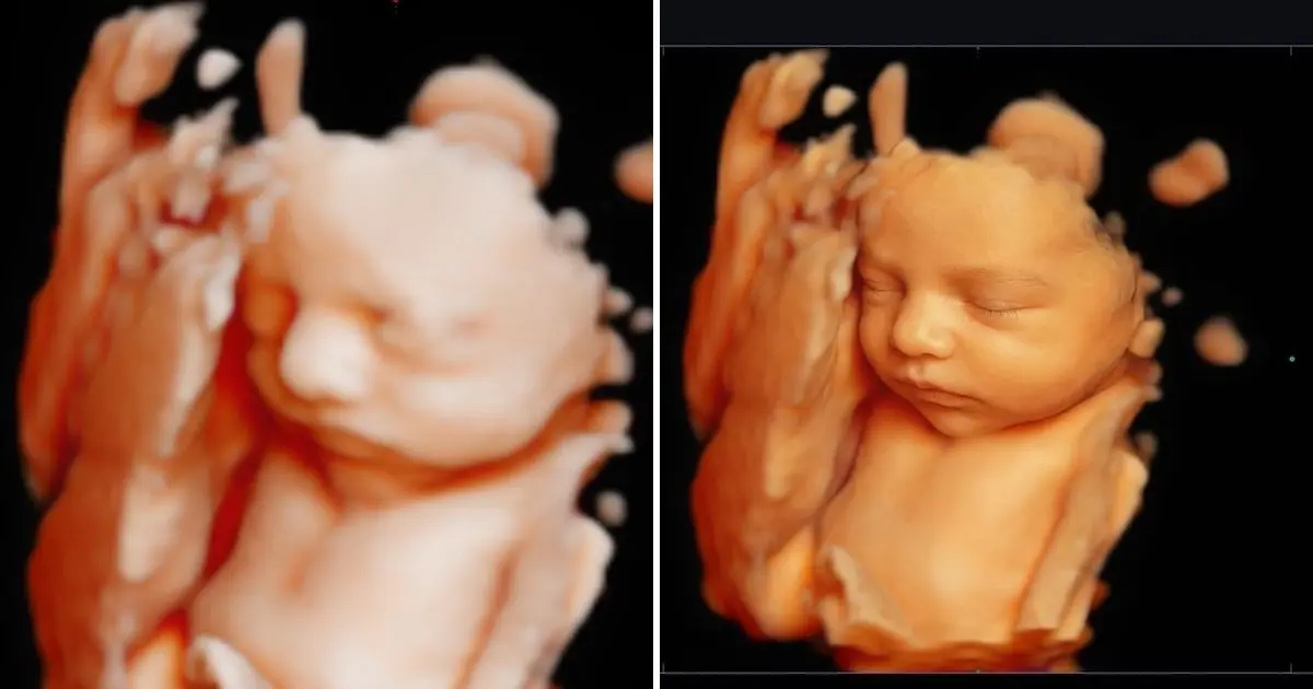 Ultrassom 3D de um bebê com a mão no rosto e a melhoria 8K hiperrealista