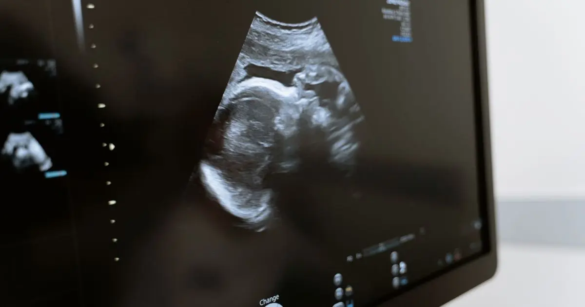 Monitor de aparelho de ultrassom mostrando o bebê de perfil em 2D