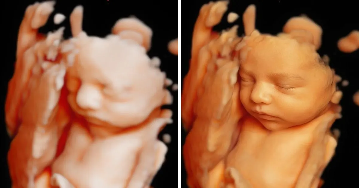 3D ultrasound of a baby with a hand near the face and its 8K hyperrealistic enhancement